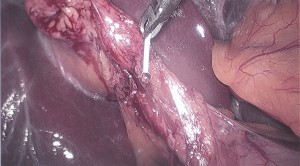 gallbladder_02