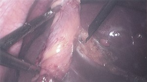 gallbladder_03